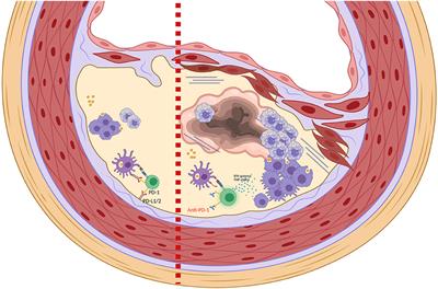 Immune Checkpoint Inhibitors and Atherosclerotic Vascular Events in Cancer Patients